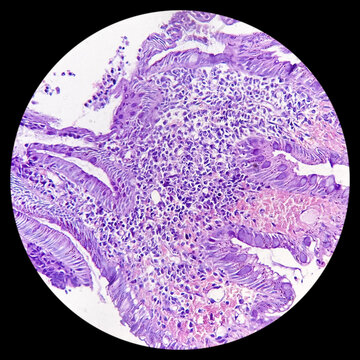 Sigmoid colon (colonoscopic biopsy): Chronic nonspecific colitis. Show colonic mucosa, chronic inflammatory cells infiltration in the lamina propria with ulceration. IBD.