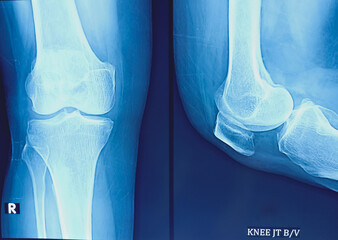 X-ray film of human's knee joint both view.