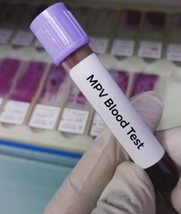 Blood sample for Mean Platelet Volume (MPV) test, MPV blood test, to measures the average size of...
