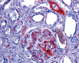 Human kidney. Amyloidosis, Congo red