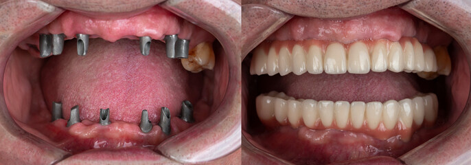 before and after pictures of dental implants and press ceramic crowns