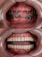 before and after pictures of dental implants and press ceramic crowns - obrazy, fototapety, plakaty