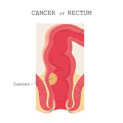 Colon cancer anatomy. illustration diagram in cartoon style.