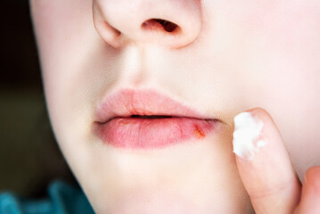 Girl's lips affected by herpes.