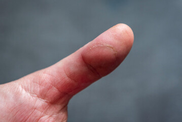 Finger with scar after being cut with knife.
