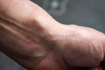 Female hand with a hygroma or wrist ganglion cyst.