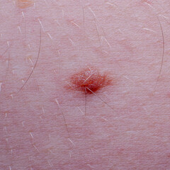 Nevus or mole on the skin of an adult