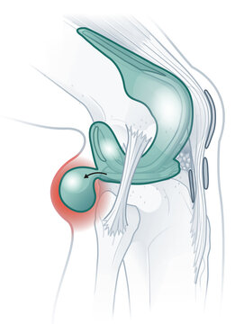 Baker's cyst of the knee. Medically illustration
