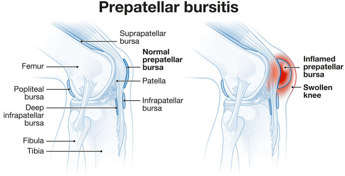 Prepatellar bursitis. Inflammation of the bursa in front of the kneecap. Labeled illustration