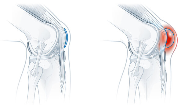 Prepatellar bursitis. Inflammation of the bursa in front of the kneecap.  illustration