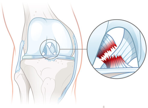 Anterior cruciate ligament tear. Knee injury. Medically illustration