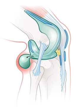 Baker's cyst of the knee. Medically illustration