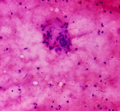 FNA from paravertebral mass. Suppurative inflammation. Smear show plenty of degenerated and intact polymorphs, lymphocytes and histiocytes.