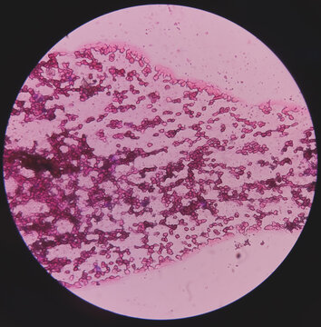 Microscopic image of ankle joint fluid. Osteochondroma disease. Osteochondrama is the most common benign tumor of bone. show bony chips and cartilage.