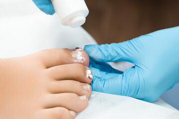 Antibiotic powder is used for treating various fungal or bacterial infections on the toenails by podologist in the clinic