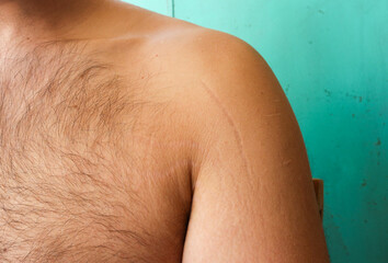 Embracing Change: Understanding and Treating Stretch Marks on Male Arms and Chest