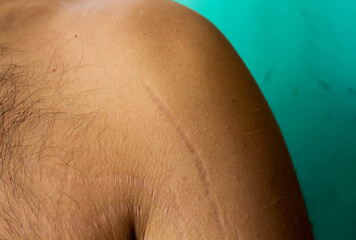Embracing Change: Understanding and Treating Stretch Marks on Male Arms and Chest