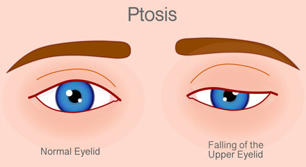 Ptosis, falling eye upper eyelid droop over eye. Droopy, lazy eye. Skin color back. Vector illustration - obrazy, fototapety, plakaty