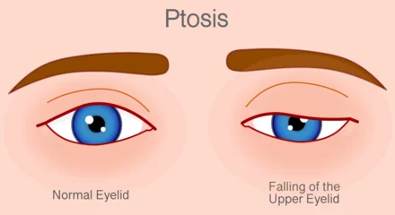 Deurstickers Ptosis, falling eye upper eyelid droop over eye. Droopy, lazy eye. Skin color back. Vector illustration © LuckySoul