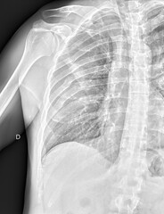 X ray still of broken ribs close up still