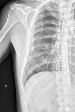 X ray still of broken ribs close up still