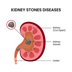 human kidney stone disease infographic