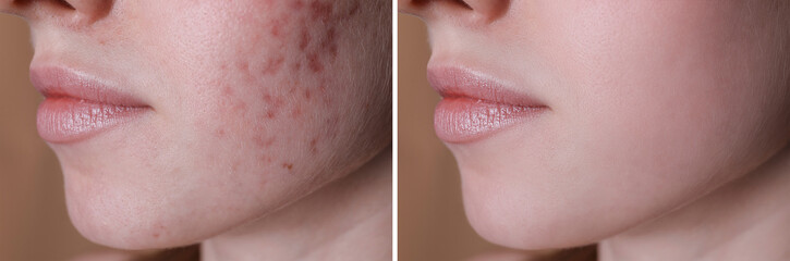Acne problem. Young woman before and after treatment on beige background, closeup. Collage of photos