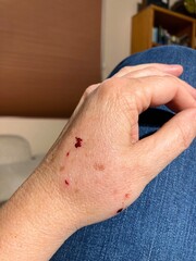 Close up of older woman's hand shows swelling and beginning of infection after cat bite