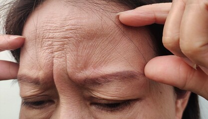 Fototapeta premium close up of a person holding the flabbiness and wrinkle, forehead lines and loose, Flabby skin and dark spots on the face of the woman, health care and beauty concept.