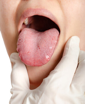 Woman with geographical tongue. Migratory glossitis.