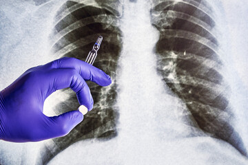 A hand in a blue medical glove holds a pill and an ampoule against the background of an X-ray of the lungs
