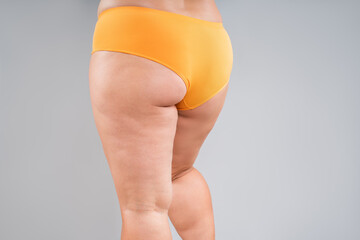 Overweight thighs, woman with fat hips, legs and buttocks, obesity female body with cellulite on gray background - 771413844