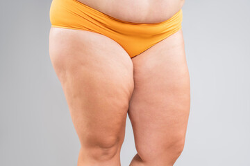 Overweight thighs, woman with fat hips and legs, obesity female body with cellulite on gray background - 771413861