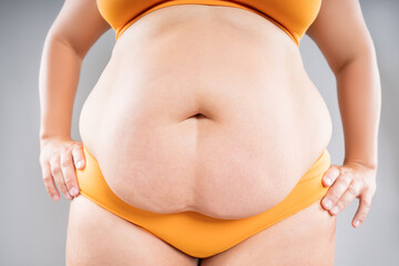 Tummy tuck, flabby skin on a fat belly, abdomen with obesity and cellulite, saggy stomach, plastic...