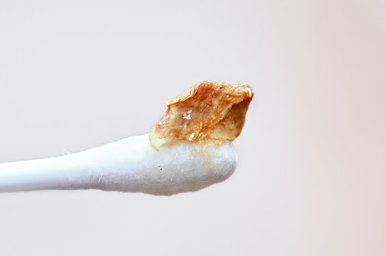 Ear wax plug isolated on white background. Removed giant ear wax plug on cotton swab closeup. Wax, which is also called cerumen on swab, macro shot. Cotton swab and ear hygiene. Remove earwax buildup