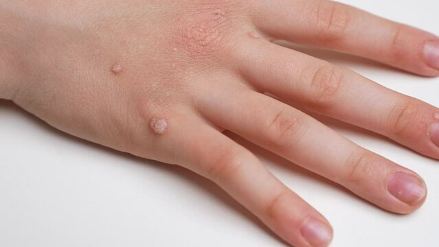 Child hand with common viral warts Verruca vulgaris - flat warts, close-up. Human papillomavirus HPV. Pediatric dermatology concept