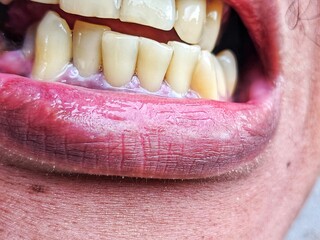 cavities and yellow teeth in humans