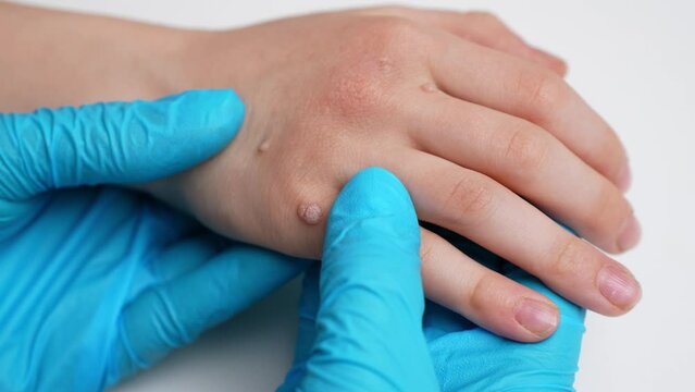 Doctor examines a child hand affected by viral warts Verruca vulgaris, close-up. Papillomavirus, HPV. Pediatric dermatology. Skin diseases. 
