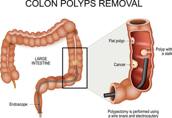 Colon polyps removal. Colonoscopy and Polypectomy.