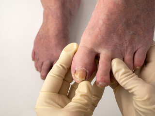 Toenail fungus. A podologist examines toenails affected by a fungal infection. Onycholysis of...