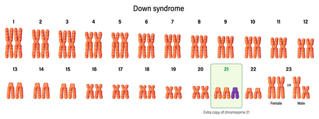 karyotype of Down syndrome. Autosomal abnormalities. Trisomy 21. Genetic disorder caused when abnormal cell division results in an extra full.