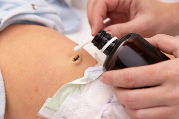 Mother hands cleaning newborn baby navel with a cotton swab and hydrogen peroxide. Treat the navel...