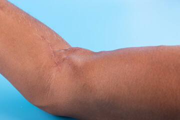Fistula on the arm as a result of an operation for hemodialysis with kidney failure.