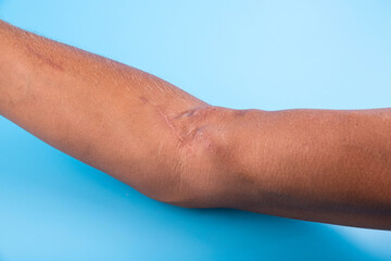Fistula on the arm as a result of an operation for hemodialysis with kidney failure.