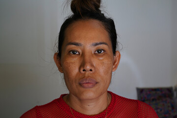 Freckles and Spot melasma pigmentation skin facial treatment over Asian woman face.