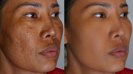 Freckles and Spot melasma pigmentation skin facial treatment over Asian woman face.