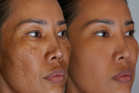 Freckles and Spot melasma pigmentation skin facial treatment over Asian woman face.