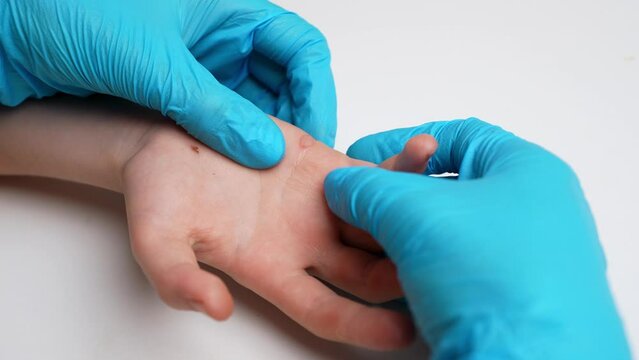  Dermatologist examines child hand, palm affected by viral flat warts Verruca vulgaris, close-up. Papillomavirus, HPV. Pediatric dermatology, skin diseases. Immunity reduction concept