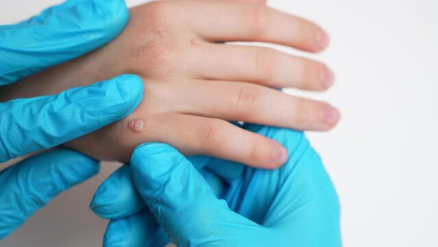 Close-up of doctor wearing blue gloves examining child hand affected by viral warts Verruca vulgaris. Papillomavirus, HPV. Concept pediatric dermatology, skin diseases