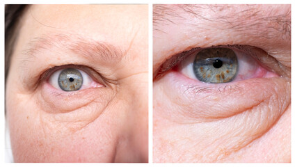 close-up part face middle-aged woman in two versions, puffiness under lower eyelid, wrinkles on...
